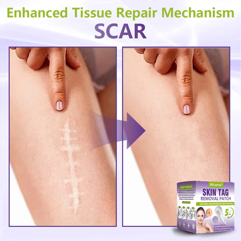 Alcuras® Soluble Microneedle Botanical Skin Tag Removal Patch