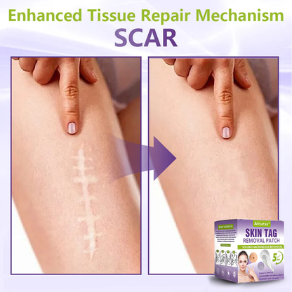 Alcuras® Soluble Microneedle Botanical Skin Tag Removal Patch