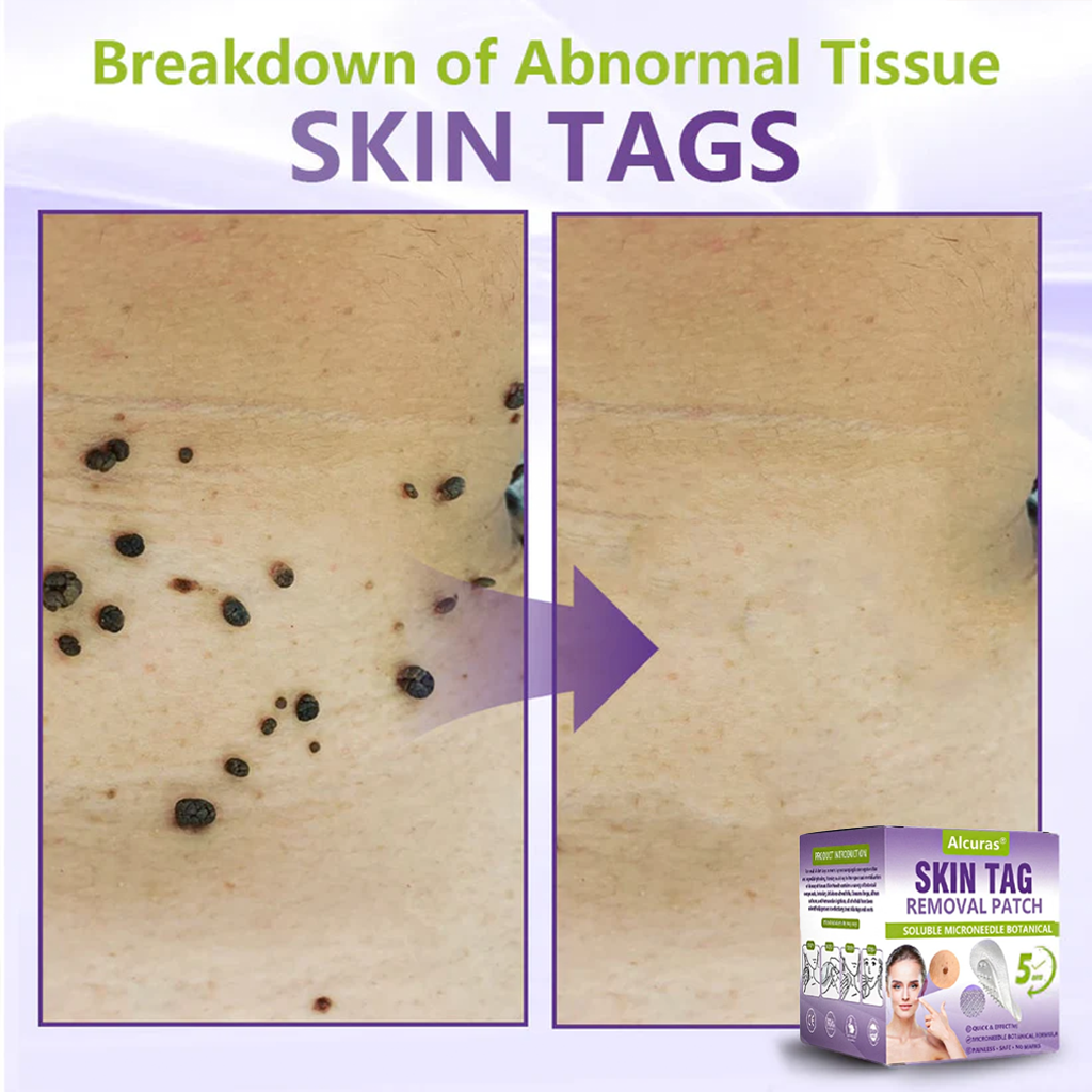 Alcuras® Soluble Microneedle Botanical Skin Tag Removal Patch
