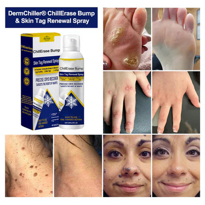 Alcuras® ChillErase Bump & Skin Tag Renewal Spray
