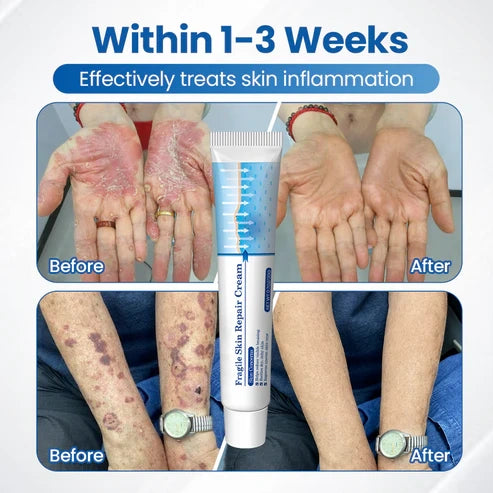Alcuras® Fragile Skin Repair Cream🛡️🌿 Multi-Repair for Bruises, Dryness & Spots