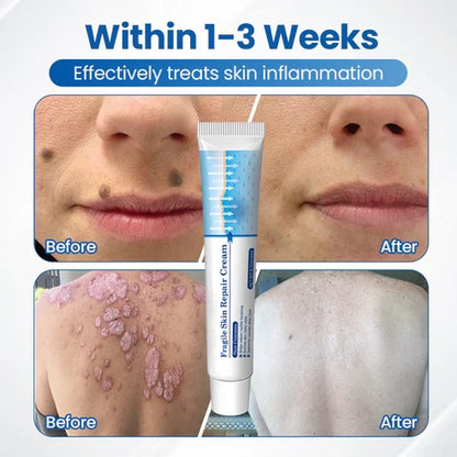 Alcuras® Fragile Skin Repair Cream🛡️🌿 Multi-Repair for Bruises, Dryness & Spots
