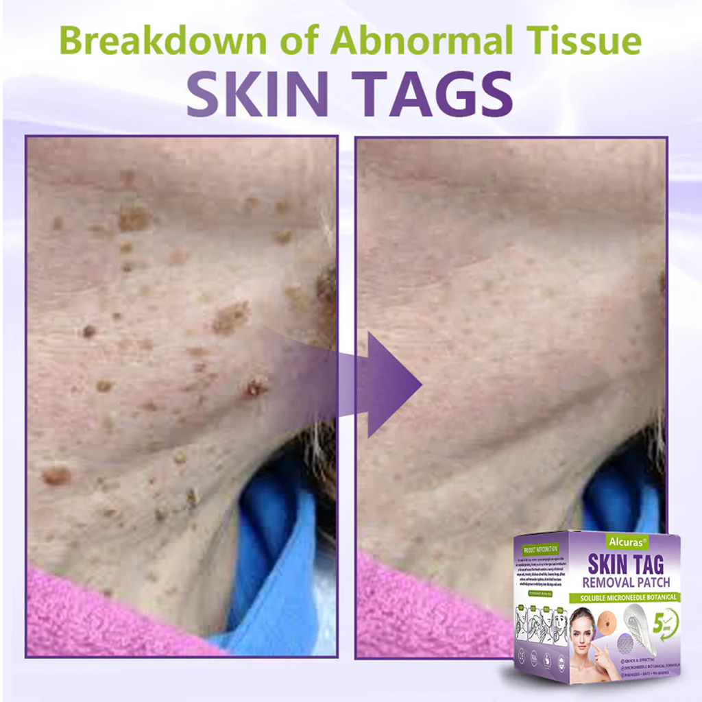 Alcuras® Soluble Microneedle Botanical Skin Tag Removal Patch