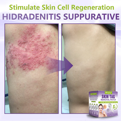 Alcuras® Soluble Microneedle Botanical Skin Tag Removal Patch
