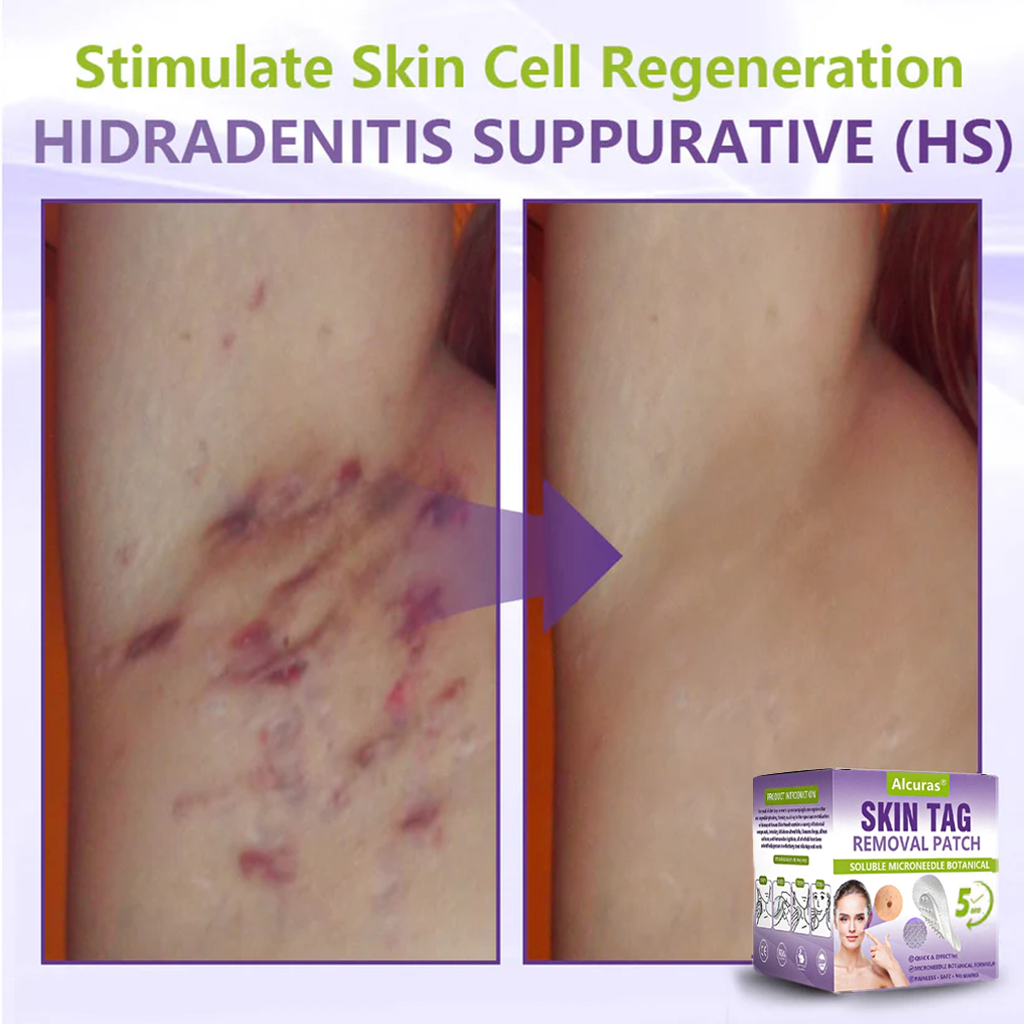 Alcuras® Soluble Microneedle Botanical Skin Tag Removal Patch