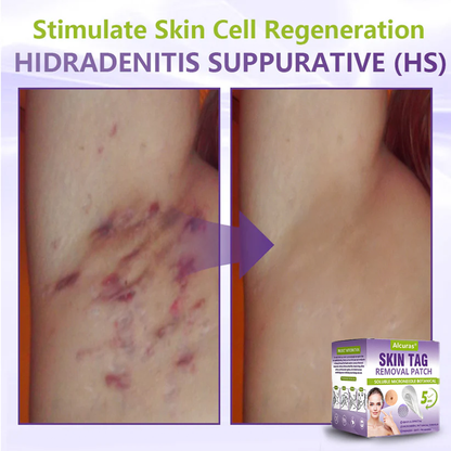 Alcuras® Soluble Microneedle Botanical Skin Tag Removal Patch