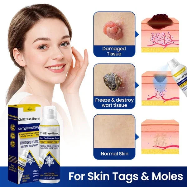 Alcuras® ChillErase Bump & Skin Tag Renewal Spray