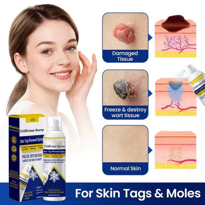 Alcuras® ChillErase Bump & Skin Tag Renewal Spray