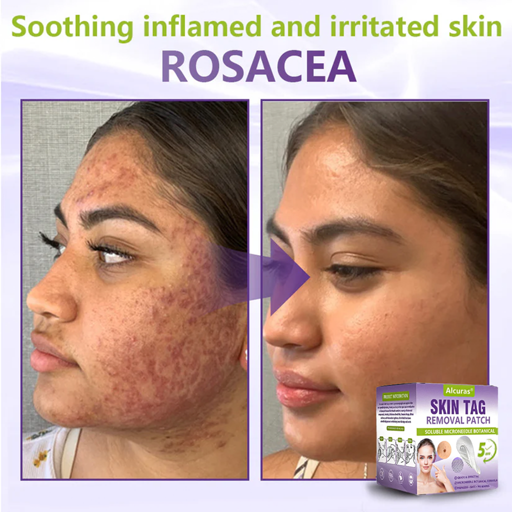 Alcuras® Soluble Microneedle Botanical Skin Tag Removal Patch