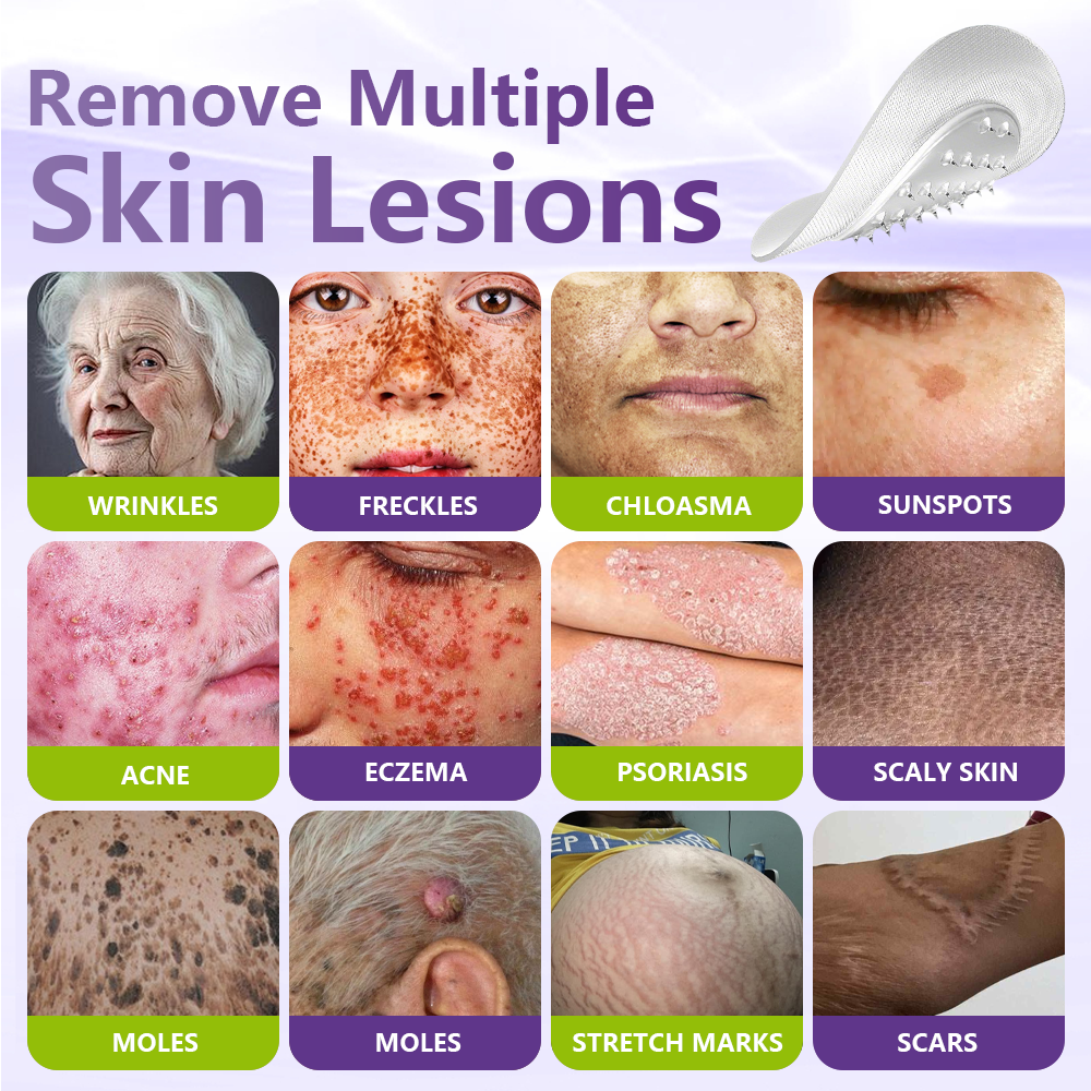 Alcuras® Soluble Microneedle Botanical Skin Tag Removal Patch