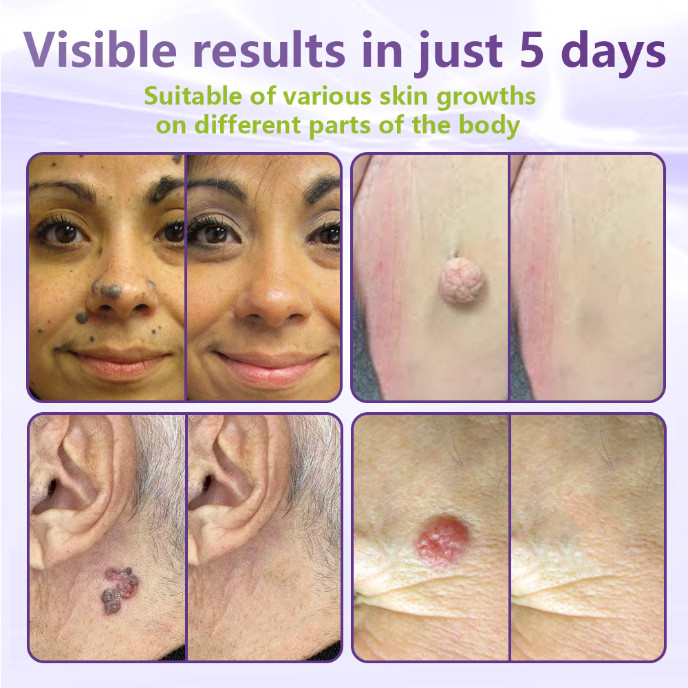 Alcuras® Soluble Microneedle Botanical Skin Tag Removal Patch
