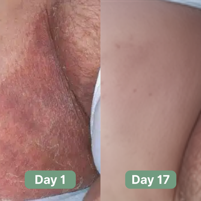 Alcuras® Antifungal Soap®
