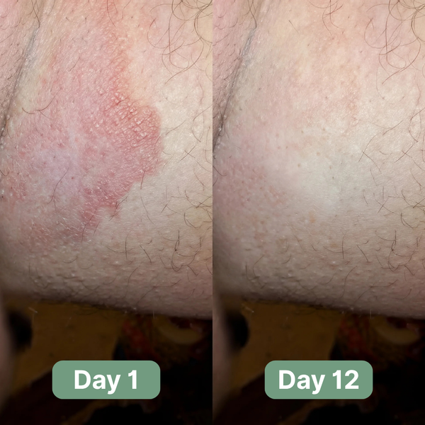Alcuras® Antifungal Soap®