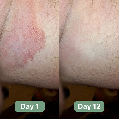 Alcuras® Antifungal Soap®